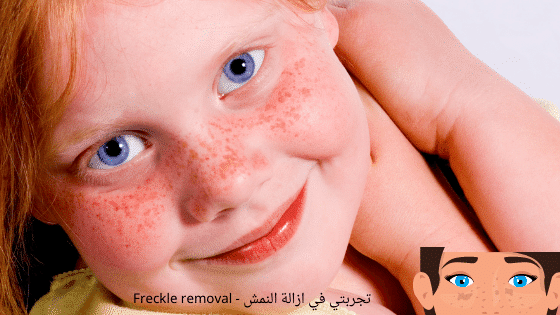 تجربتي في ازالة النمش - Freckle removal