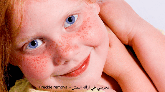 تجربتي في ازالة النمش - Freckle removal